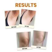 6 - myUpchar Ayurveda Brightening & Whitening Body Cream, 50 g for Dark Patches